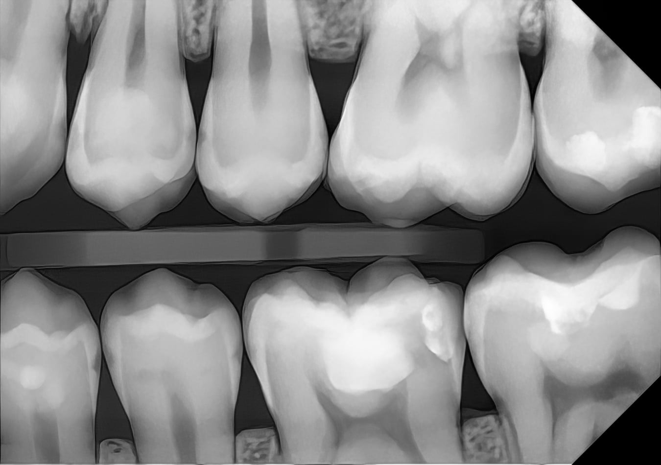 A digital bitewing x-ray of the back teeth, showing fillings and the spaces between teeth
