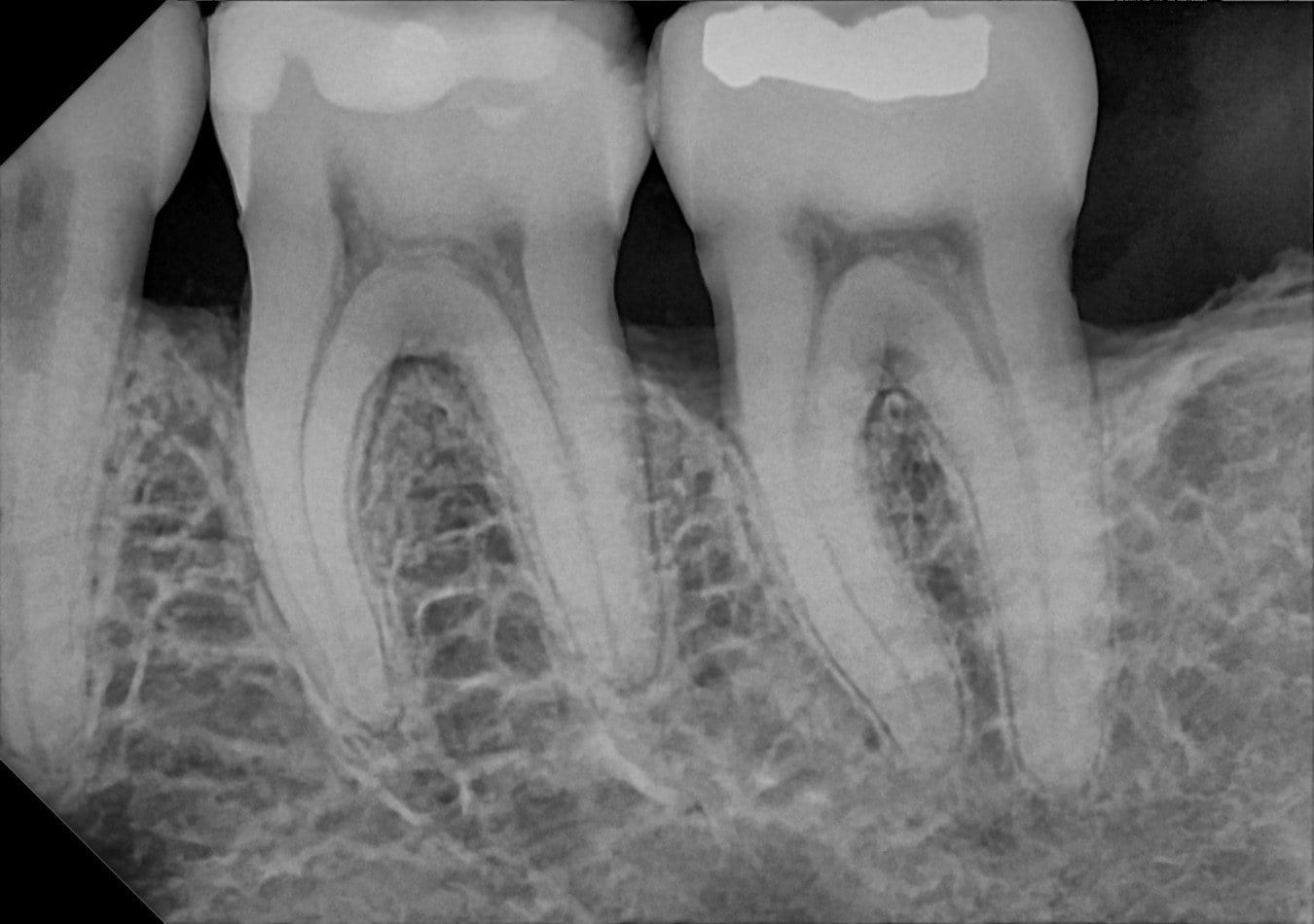 A digital x-ray of lower molars, showing the roots and the bone around them in fine detail